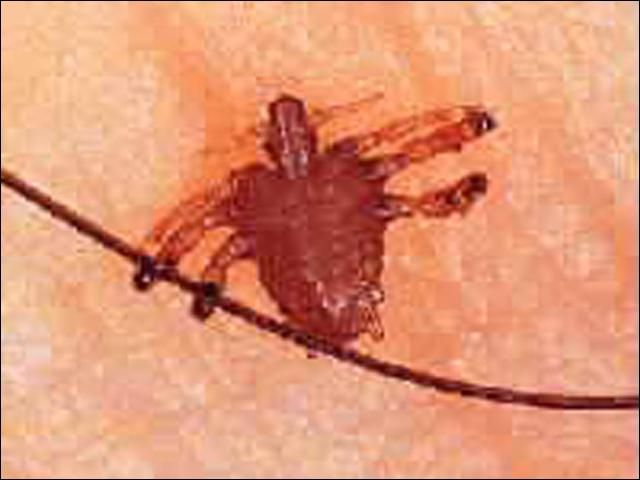 Figure 2. Pubic louse.