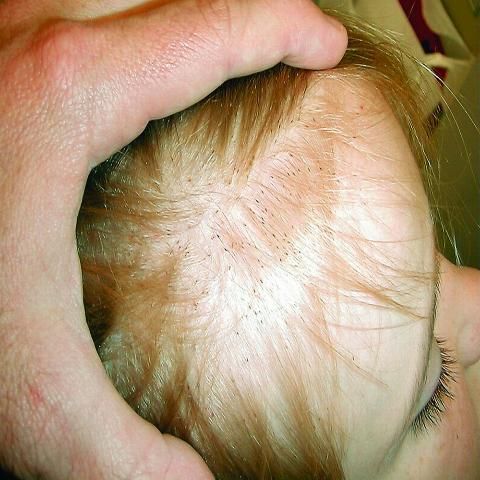 Figure 2. Head lice nits on child's hair.