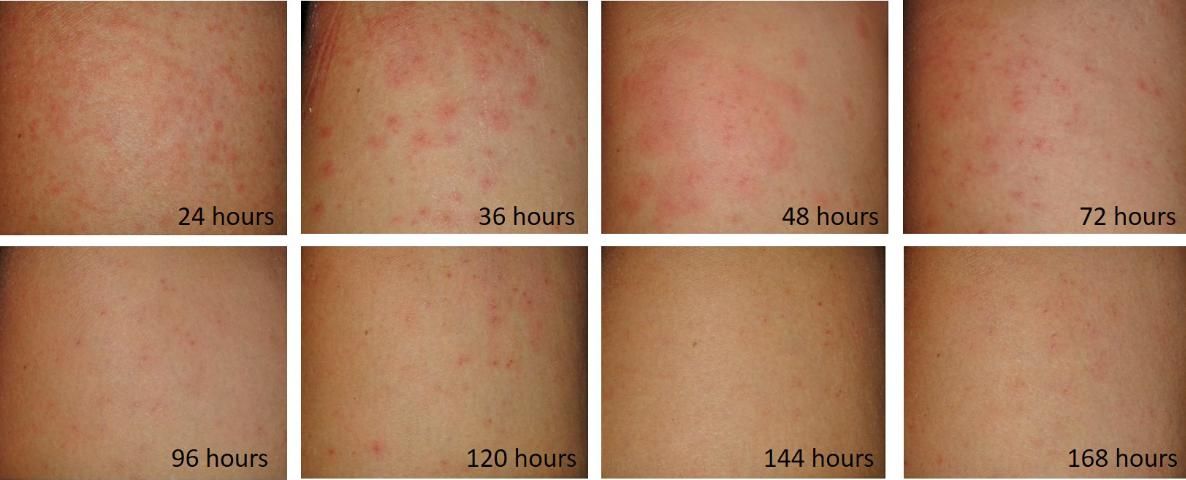 Figure 3. The development of the swimmer's itch rash over a week (168 hours), a case study.