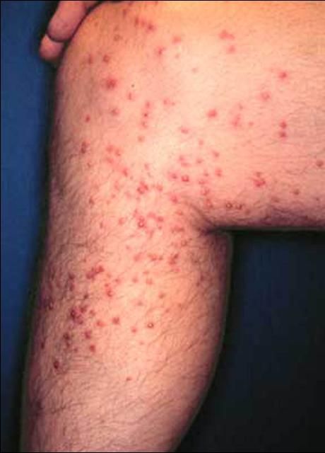 Figure 13. White pustules formed after attack by the red imported fire ant, Solenopsis invicta Buren.