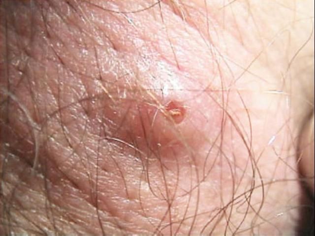 Figure 13. Raised lesion on the skin caused by the presence of a larva of the human bot fly, Dermatobia hominis (Linnaeus Jr.).