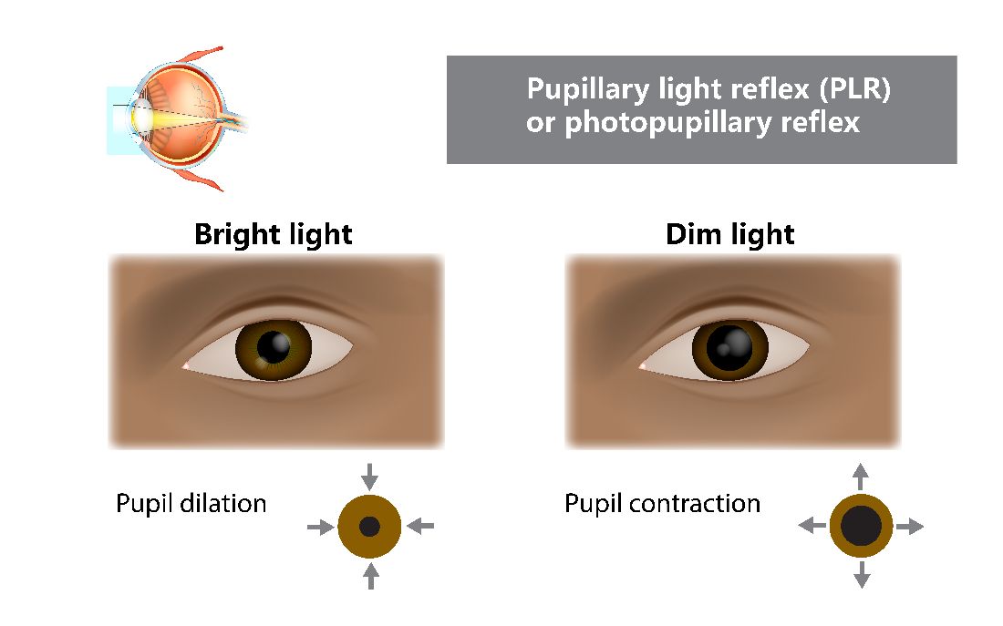 A diagram showing what your pupil looks like when it is dilated and contracted. 