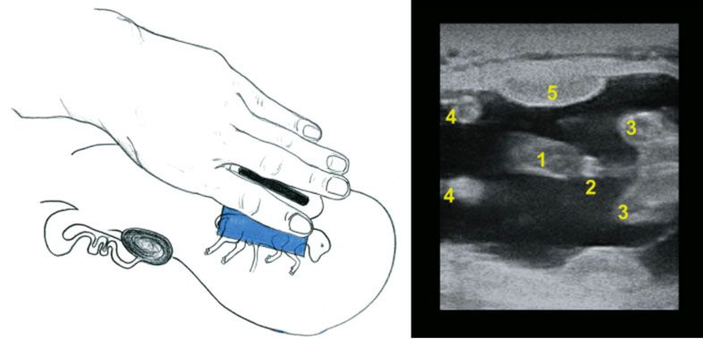 Male fetus at 65 days of gestation in longitudinal plane. The left side of the figure shows the position of the probe in relation to the fetus inside the uterus. The right side of the figure shows what will be seen on the screen at the same moment. Note that the free part of the probe appears on the left side of the ultrasound image. 1: Umbilicus; 2: Genital tubercle; 3: Hindlimbs; 4: Forelimbs; 5: Placentome. 