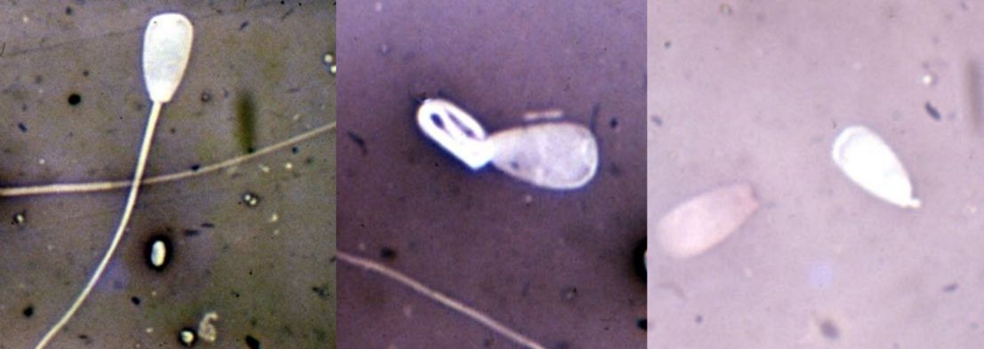 A spermatozoon with a normal appearance is seen under the microscope (left panel). The spermatozoon is abnormal because it has a tight, coiled tail and midpiece (central panel). A normal head shape is shown on the right (whitehead); however, it is a detached head, which is considered abnormal. The pink detached head on the left was stained with eosin, which indicates it was dead (right panel). 