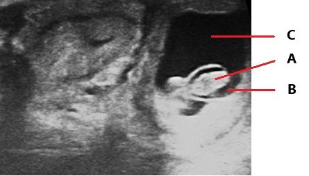 Ultrasonography image of the uterine body of a pregnant cow at 60 days, showing the fetus (A) inside the amniotic vesicle (B) and the chorioallantoic fluid (C) surrounding it. 
