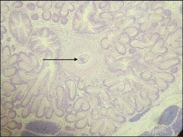Figure 4. Photomicrograph of a trematode (arrow) in a granuloma within the digestive gland of a hard clam (Mercenaria mercenaria). Magnification: 100X.