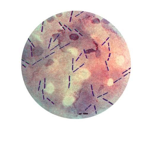 Figure 1. Photomicrographic view of a Gram-stained culture speciminen, revealing the presence of numerous Clostridium perfringens Gram-positive bacteria.