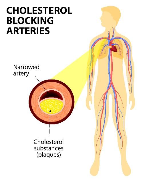 Figure 1. High blood pressure contributes to plaque buildup in the coronary arteries, which can cause chest pain (angina) and a heart attack.
