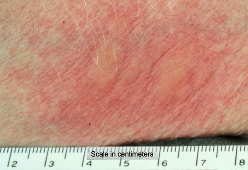 Figure 26. Pruritic welts and erythema resulting from rubbing hairs from the dorsal tussocks of the fir tussock moth (Orgyia detrita) onto the author's forearm.