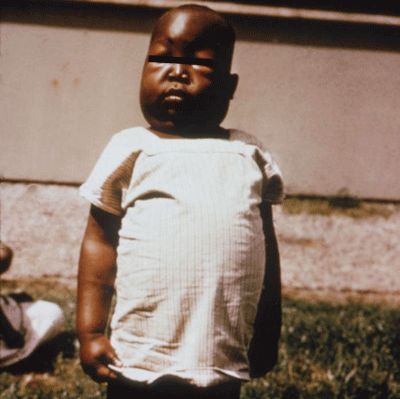 Figure 10. Swelling of the abdomen, eyes, feet and hands are a common symptom of kidney damage associated with infection by one type of malaria, Plasmodium falciparum.