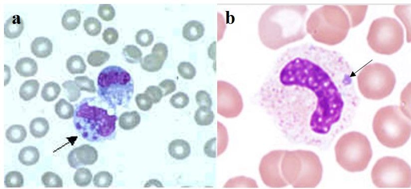 a: Stained blood showing Ehrlichia chaffeensis (arrow) in a white blood cell. b: Stained blood smear showing Anaplasma phagocytophilum (arrow) in a white blood cell. 