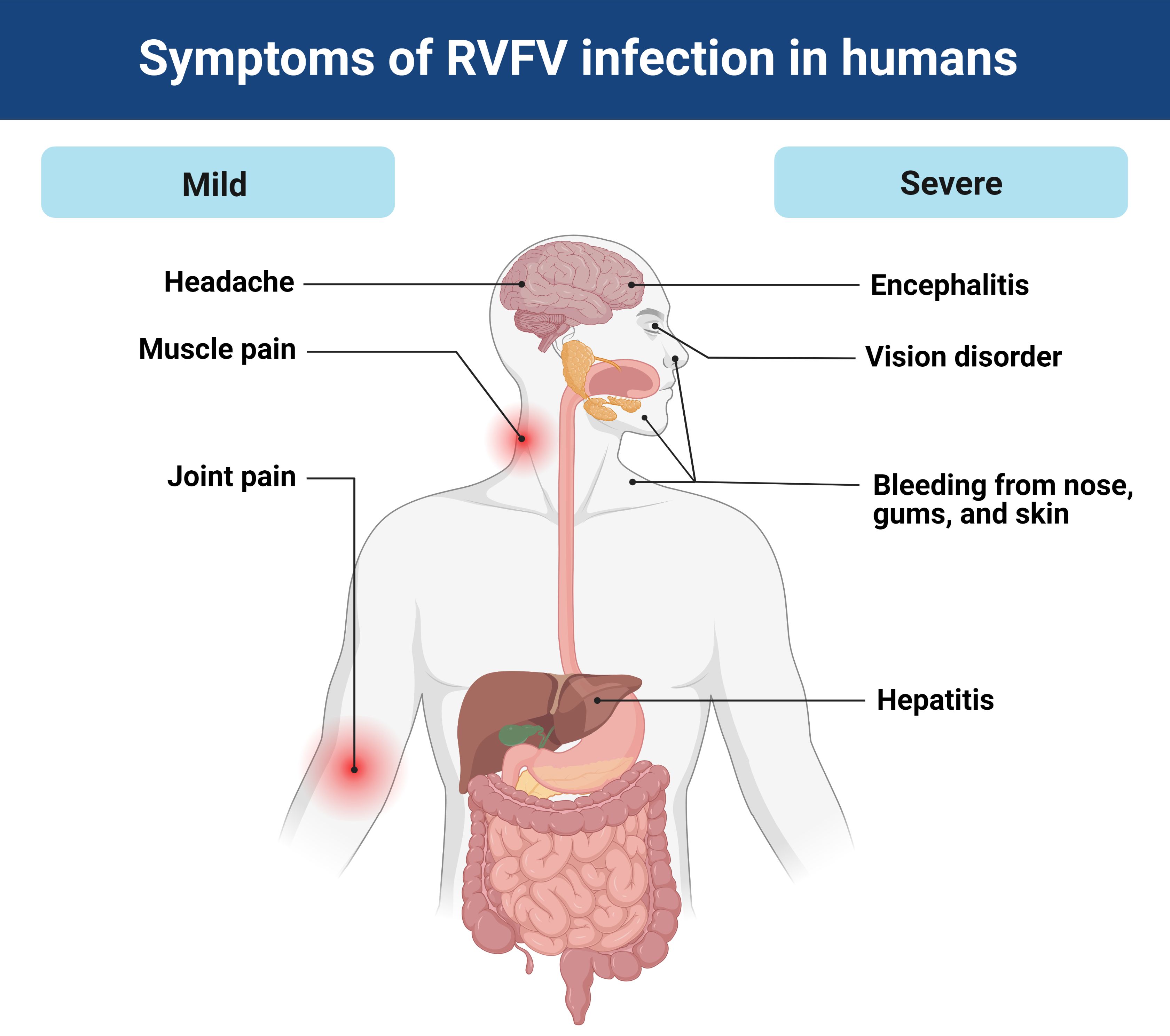 RVFV infection manifestations in humans. 