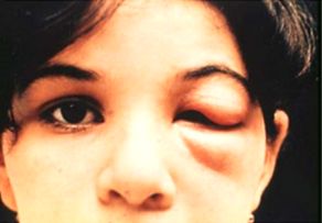A characteristic example of a Romaña’s sign, a red, raised nodule that can develop at a T. cruzi infection site near the eye, in a child. 