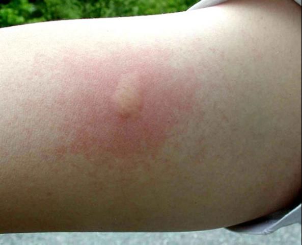 Figure 5. Symptoms of an individual sting by the European fire ant, Myrmica rubra Linnaeus.