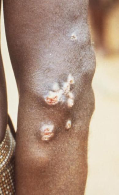Figure 6. This person has yaws with 8 month-old juxta-articular nodules on the left elbow.