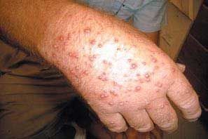 Pustules formed from fire ants stings on adult hand.