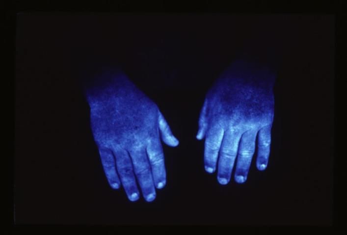 Figure 6. An example of pesticide exposure on hands.