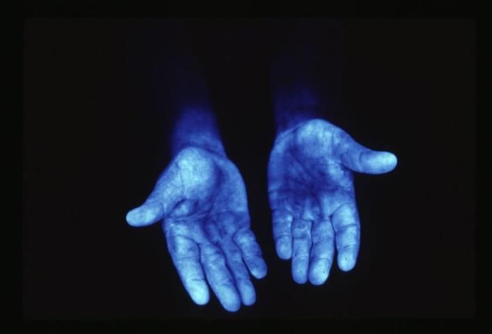 Figure 5. An example of pesticide exposure on hands.