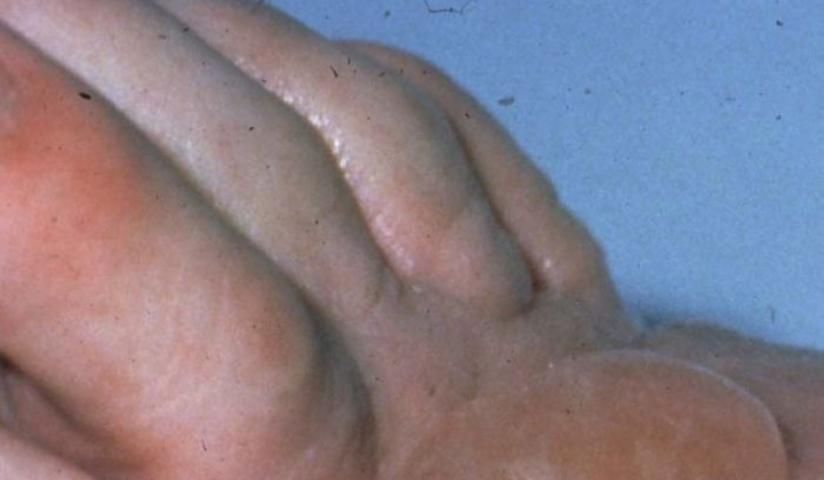 Figure 17. Ampollas en la piel provocadas por la exposición de bromuro de metilo en el pie.
