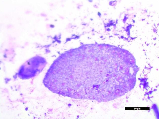 Figure 25. A large ciliate in a stained preparation from a fecal direct smear stained with Wright-Giemsa. The morphology of this organism is suggestive of Biggaria spp., possibly B. bermudense.