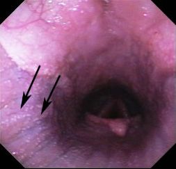 Endoscopic image of Besnoitia cysts (arrows) in the airway of a donkey with besnoitiosis. 