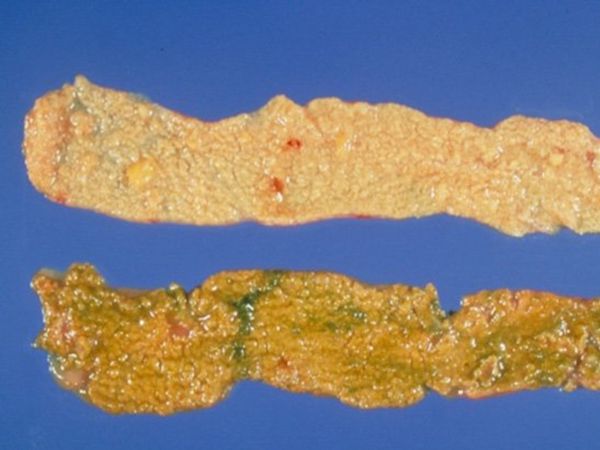 Necrotic enteritis caused by Clostridium perfringens in the small intestines of two broiler chickens.